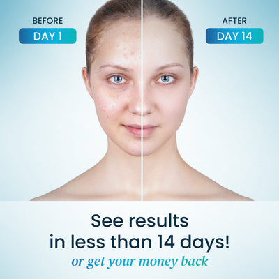 Skin Harmony - Hormonal Acne Blend